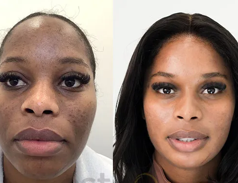 Acne Luv Skn Sessions (3)
