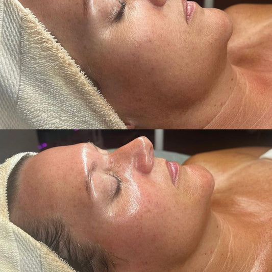 First Luv! HydroFacial